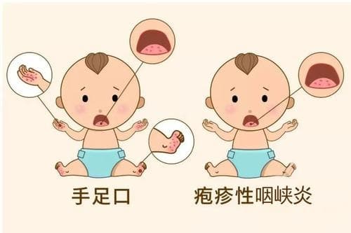 手足口病潜伏期多久