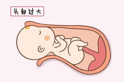 胎儿头扁属于畸形吗