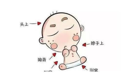 婴儿痱子怎么快速消除